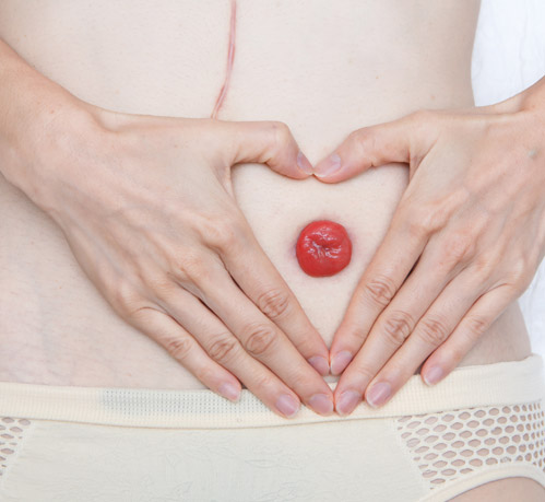 Câncer de colon Câncer de colon