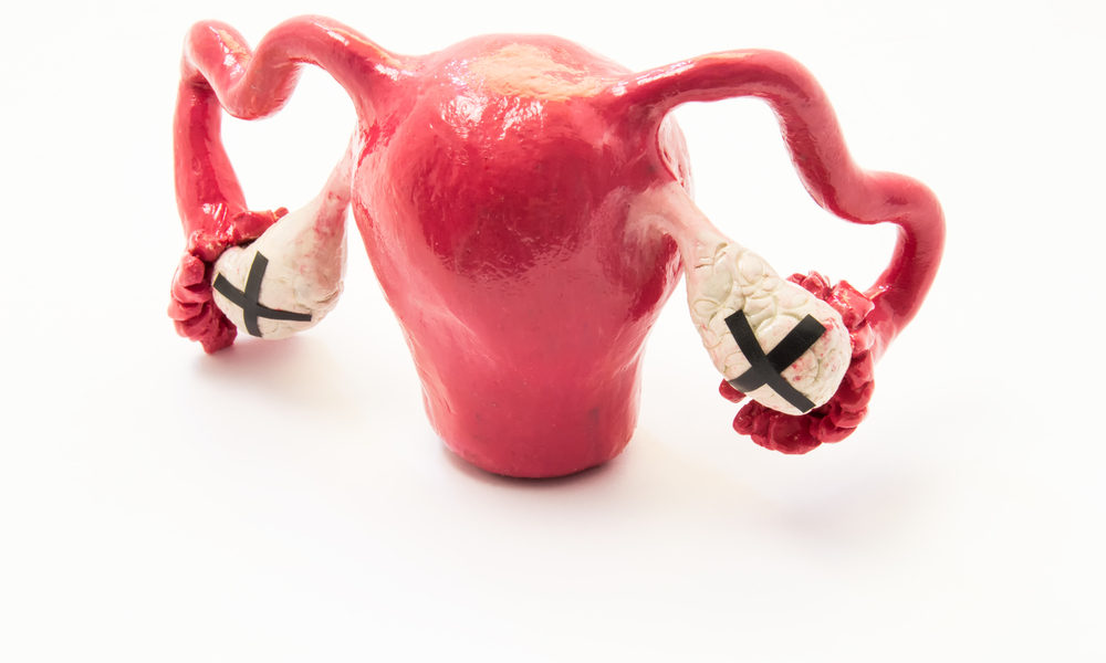 Um útero com ovários marcados com um X